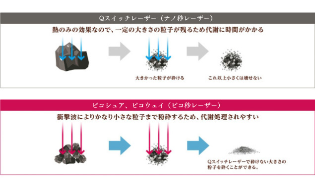 Qスイッチレーザーとピコシュアの比較