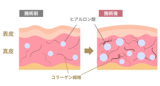 ジュビダームビスタ®ボライトXCのメカニズム